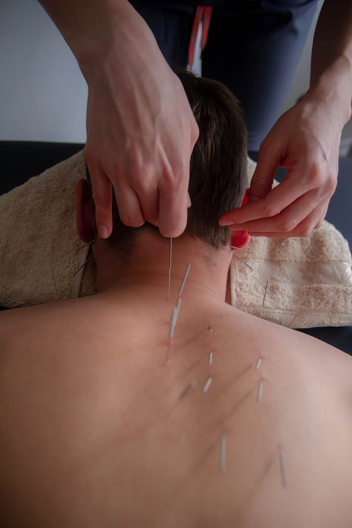Acupuncture Акупунктура