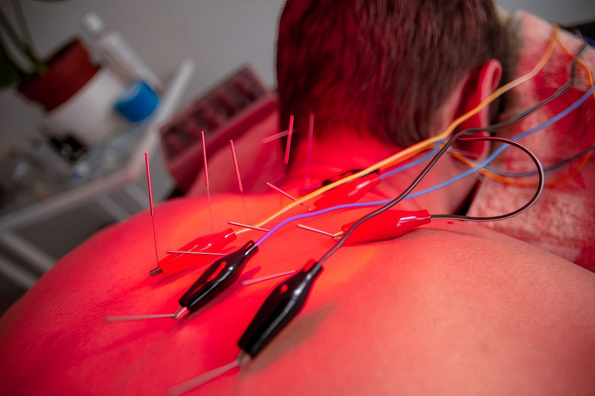 Acupuncture Акупунктура